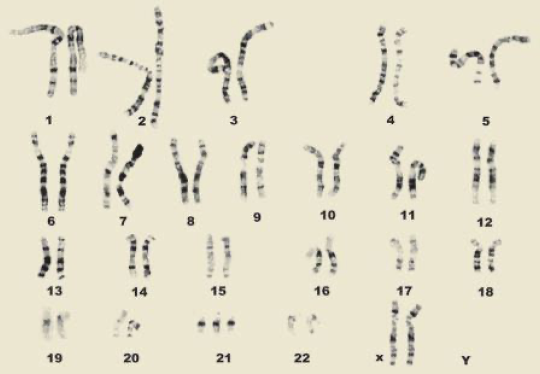 down syndrome karyotype translocation